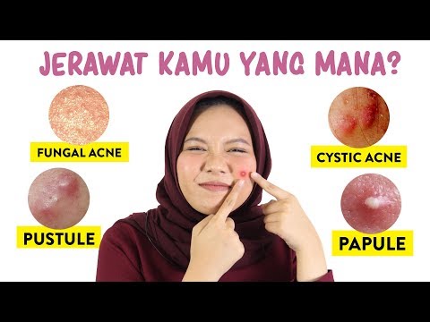 Cara Menghilangkan Komedo Untuk Anak Anak