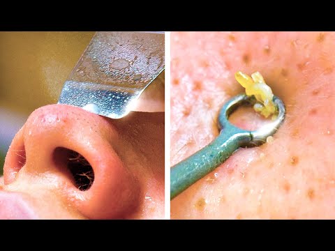 5 Masker Alami Untuk Menghilangkan Komedo Di Wajah. 